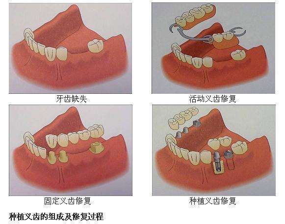 哈尔滨牙齿种植